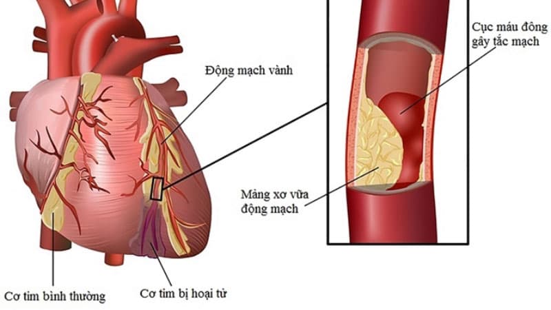 Bệnh động mạch vành