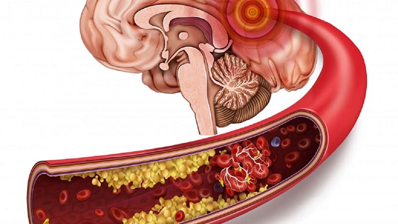 Bệnh mạch máu não
