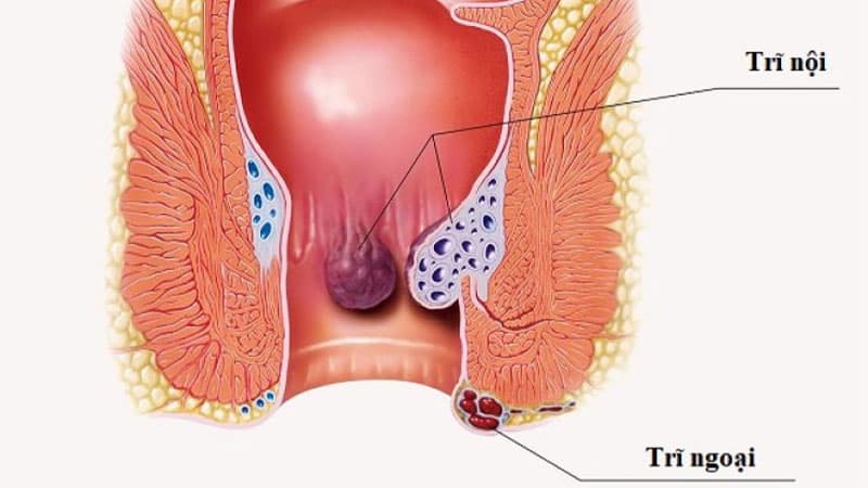 Biến chứng của bệnh trĩ nếu không được điều trị