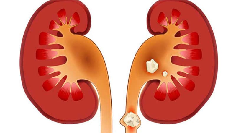 Dấu hiệu bệnh sỏi thận – Bệnh sỏi thận có di truyền không ?