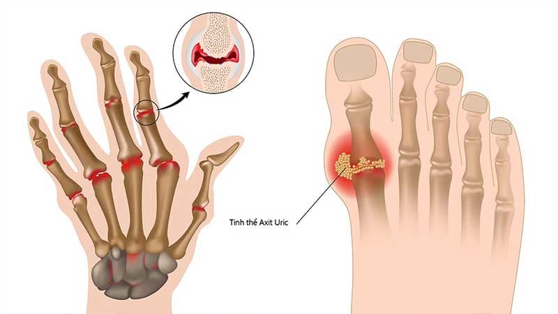 Dấu hiệu nhận biết bệnh gút