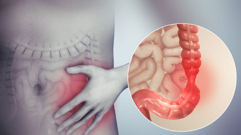 Hội chứng ruột kích thích (Irritable Bowel Syndrome)