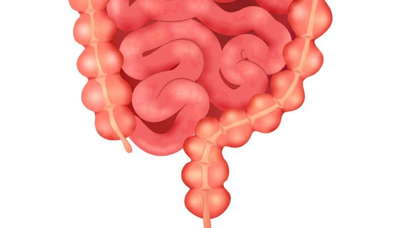 Hội chứng ruột rò (Diverticulitis)