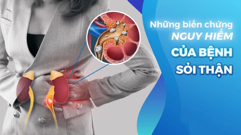 Những biến chứng nguy hiểm của bệnh sỏi thận