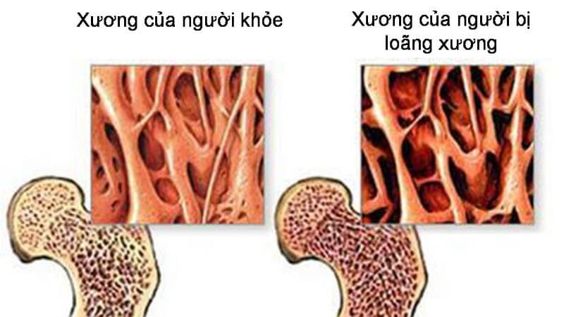 Tìm hiểu về bệnh loãng xương