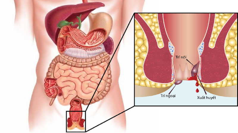 Bệnh trĩ và dấu hiệu nhận biết sớm bệnh trĩ