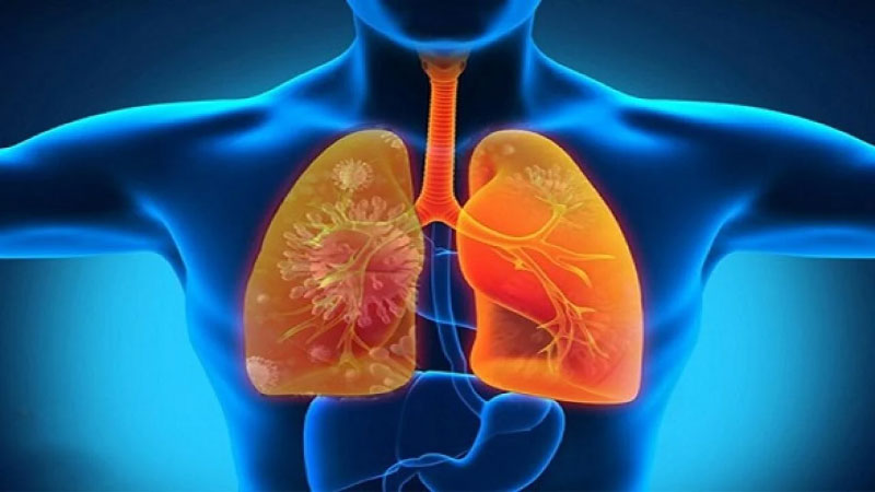 Bệnh viêm phổi: nguyên nhân – triệu chứng – phòng ngừa – điều trị