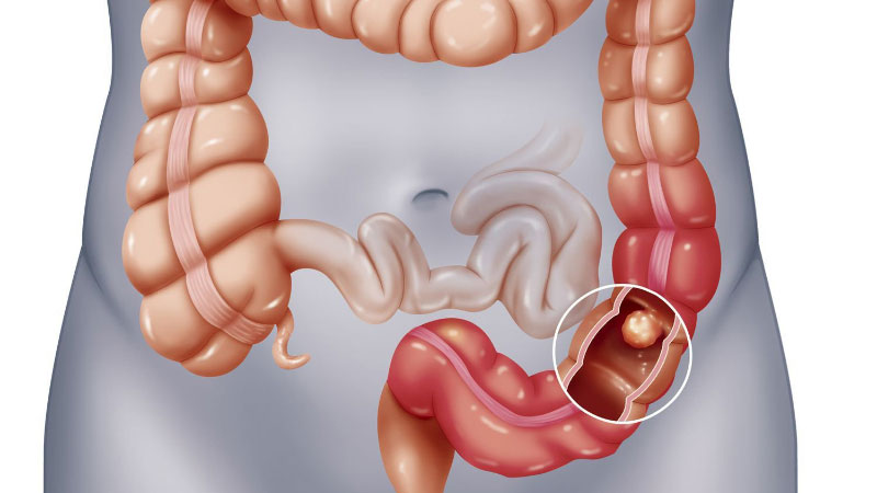 Tắc ruột (Intestinal Obstruction)
